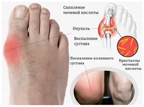 Подагрин-Подагра болезнь отложения кристаллов уратов в суставах и ...