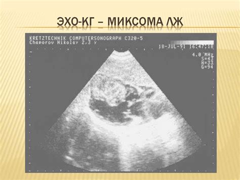 Миксома сердца - online presentation