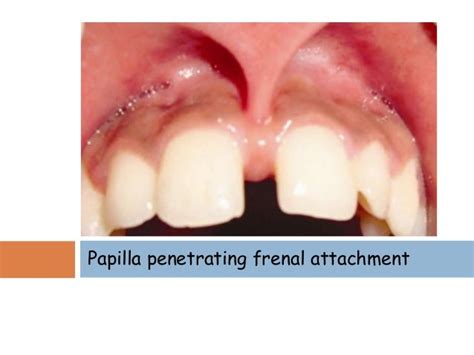 Frenum attachment and it's management.