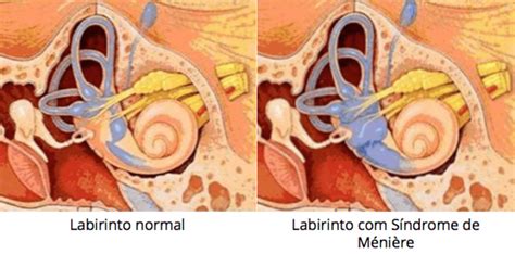 Qual O Sintoma Do Labirintite - Labirintite, você sabe o que é? – Eu Percebo