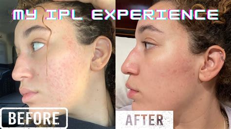 IPL Photo-Facial Laser Treatment for Acne Scarring, Hyperpigmentation ...