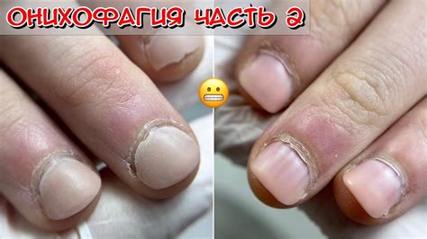 Онихофагия Что это? Часть 2 / Как лечить? / Грызет ногти подросток ...