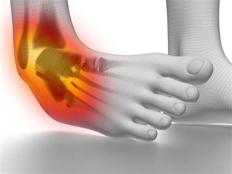 Ankle Sprain | BodyViva | Physiotherapy | Brisbane