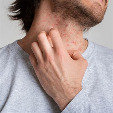 5 Dermatologist-Approved Treatments for Eczema