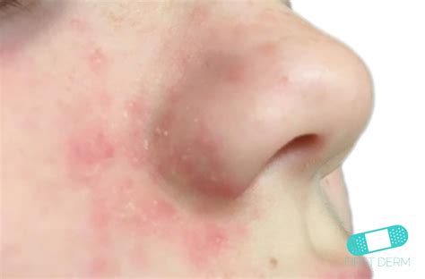 Online Dermatology - Perioral Dermatitis