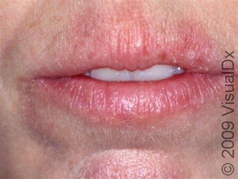 Crusty Lips
