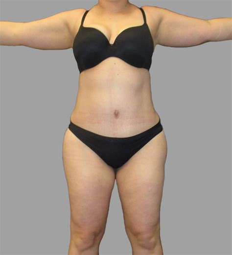 Lipo 360 - Tummy Tuck Before and After Photo Gallery | Tampa, FL | Dr