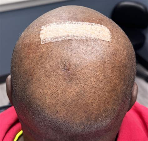 male sagittal bump skull reduction back 2 Dr Barry Eppley - Explore
