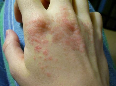 The 12 Rarest Allergies Ever - Rarest.org