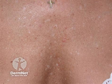 Idiopathic Guttate Hypomelanosis