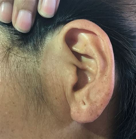 Preauricular sinus - EarAidNepal