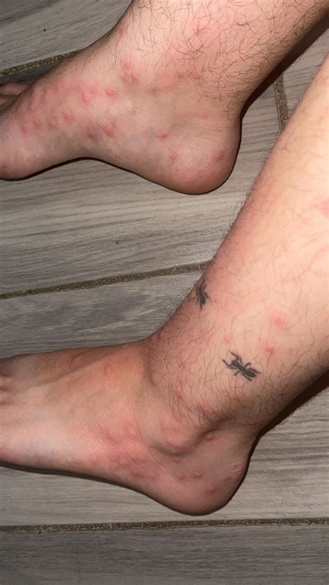sand fleas bites sand flea bite symptoms treatment   sand