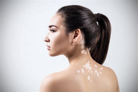 ¿El vitiligo tiene cura? Diagnósticos, tipos etc. Descúbrelo todo aquí