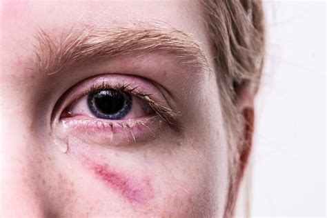 Early Warning Signs of Internal Bleeding - The Thistle Law Firm
