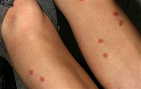 Flea Bites On Arms