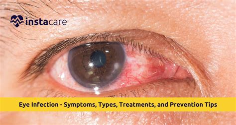 waffle eye infection