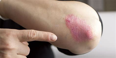 Guselkumab Self-Injector Granted FDA Approval for Plaque Psoriasis