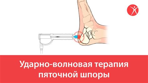 Ударно-волновая терапия пяточной шпоры - YouTube