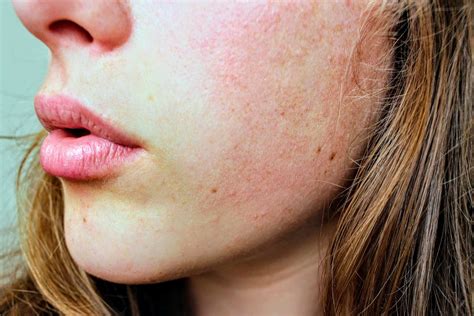 redness sensitivity broken capillaries jacalyn james skin clinic