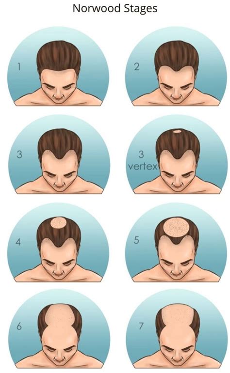 how to tell if hair is receding