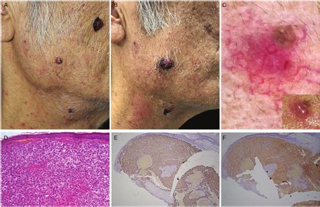 Dermoscopy of cutaneous metastases from primary hepatocellular carcinoma