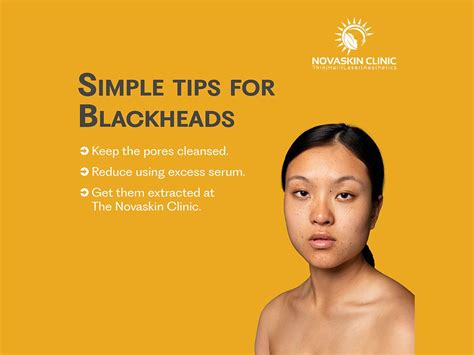 The NOVASKIN Clinic on LinkedIn: #blackheads #blackheadstips #skin # ...