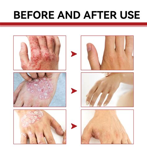 South Moon Psoriasis Cream 30g Skin Redness Swelling Pruritus Natural