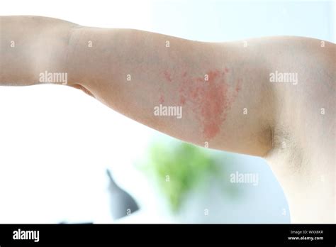 Hives Body High Resolution Stock Photography and Images - Alamy