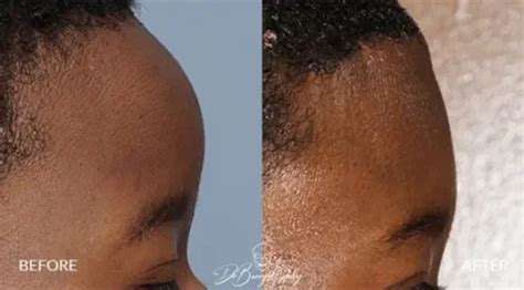 Aesthetic Forehead Surgery | Dr. Barry L. Eppley