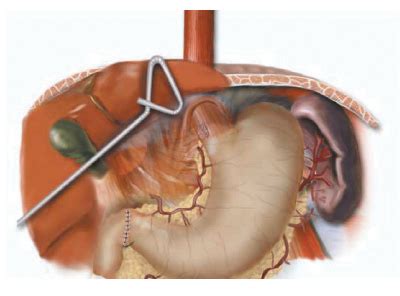 Minimally Invasive Esophagectomy | CTSNet