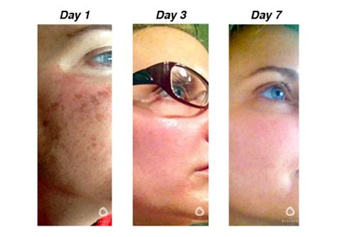 The Perfect Derma™ Chemical Peel | Cibolo Creek Dermatology Group
