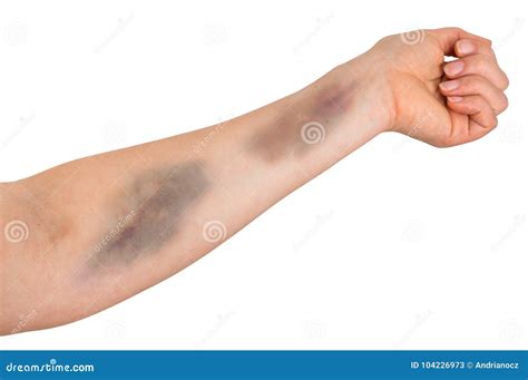 large bruise  human arm stock image image  painful