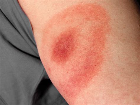 5 Common Tick Bite Symptoms, and 8 Ways to Prevent Getting Bit