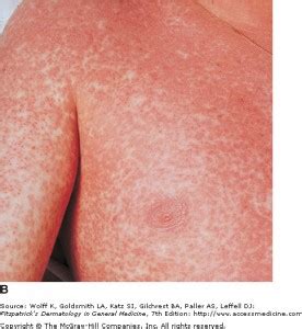 EBV-rash | Dr Alex Kumar