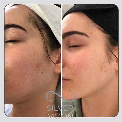 خدمات تزریق prp - مرکز تخصصی زیبایی و پزشکی ماه نقره ای