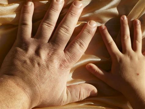 es la acromegalia en el ser humano