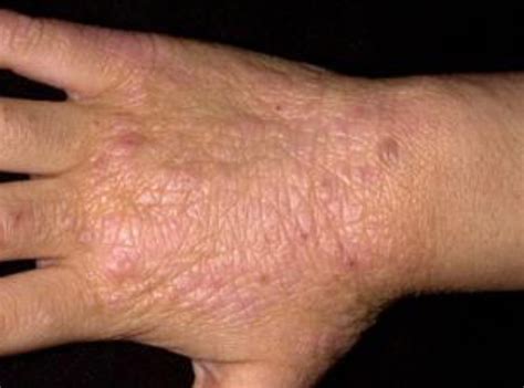 The Many Faces of Eczema Skin Rashes - Bella's Apothecary