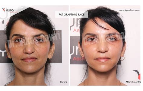 Fat Transfer To Face Ludhiana, Punjab, India