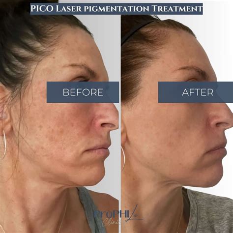 laser treatments