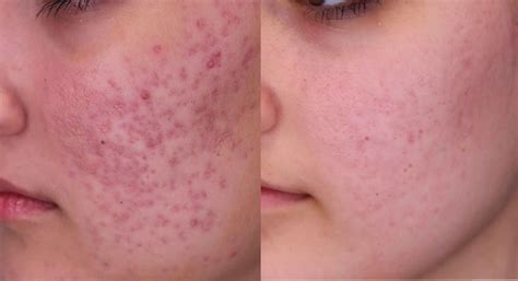 Professional Red Acne Scars Treatment Brisban - Cutis Dermatology