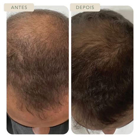 Botox Capilar Masculino Antes E Depois - Terapia Capilar - Botoclinic