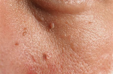 Facial Filiform Warts | Asthetiklab