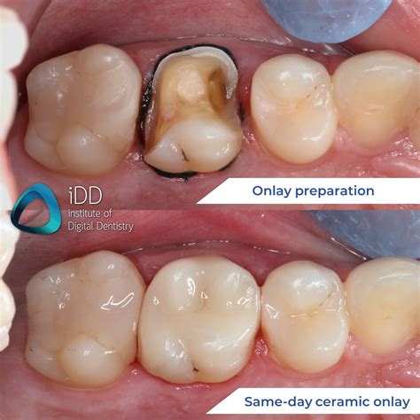 Institute of Digital Dentistry - Check out this before & after of a