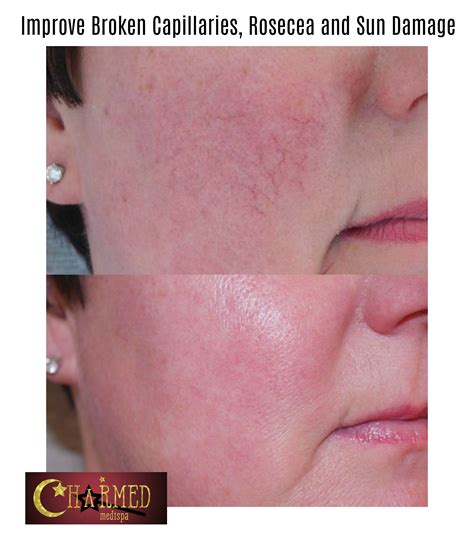 Capillaries Skin