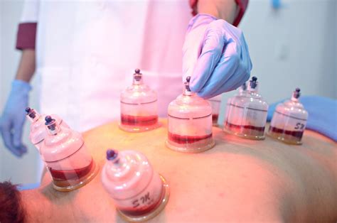 manfaat bekam badan homecare