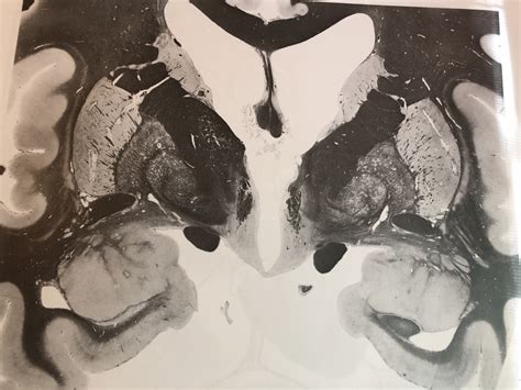 hypothalamus tuberal region diagram quizlet