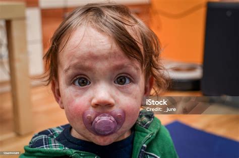 Children Viral Disease Or Allergies Red Measles Rash On Baby Stock ...