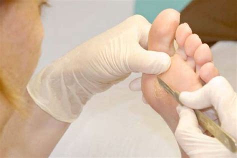 Calluses And Corns - Treatment & Home Remedies