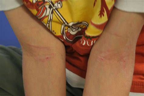 Atopic dermatitis (AD) of the flexural surfaces of the extremities ...