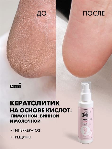 Все о кератолитиках для педикюра